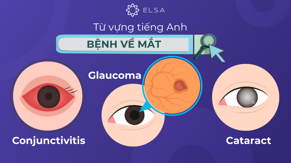 Từ vựng tiếng Anh các loại bệnh về mắt Từ vựng tiếng Anh các loại bệnh về mắt